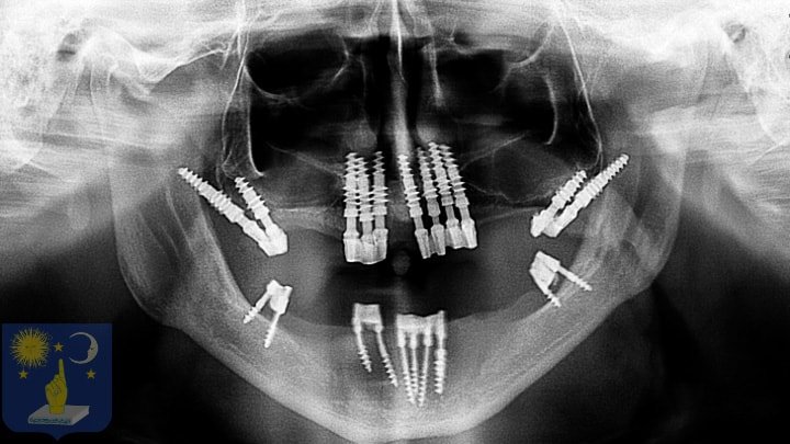 xray after dental implants