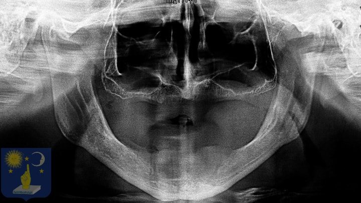 xray before dental implants